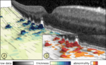 Visual Analysis of Optical Coherence Tomography Data in Ophthalmology